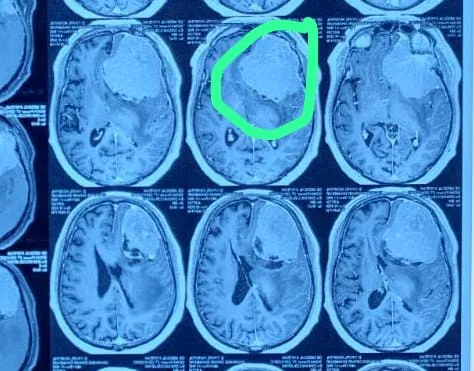 Aajchi Navi Mumbai | 64 वर्षीय रुग्णाच्या मेंदूतून काढली 700 ग्रॅम वजनाची गाठ